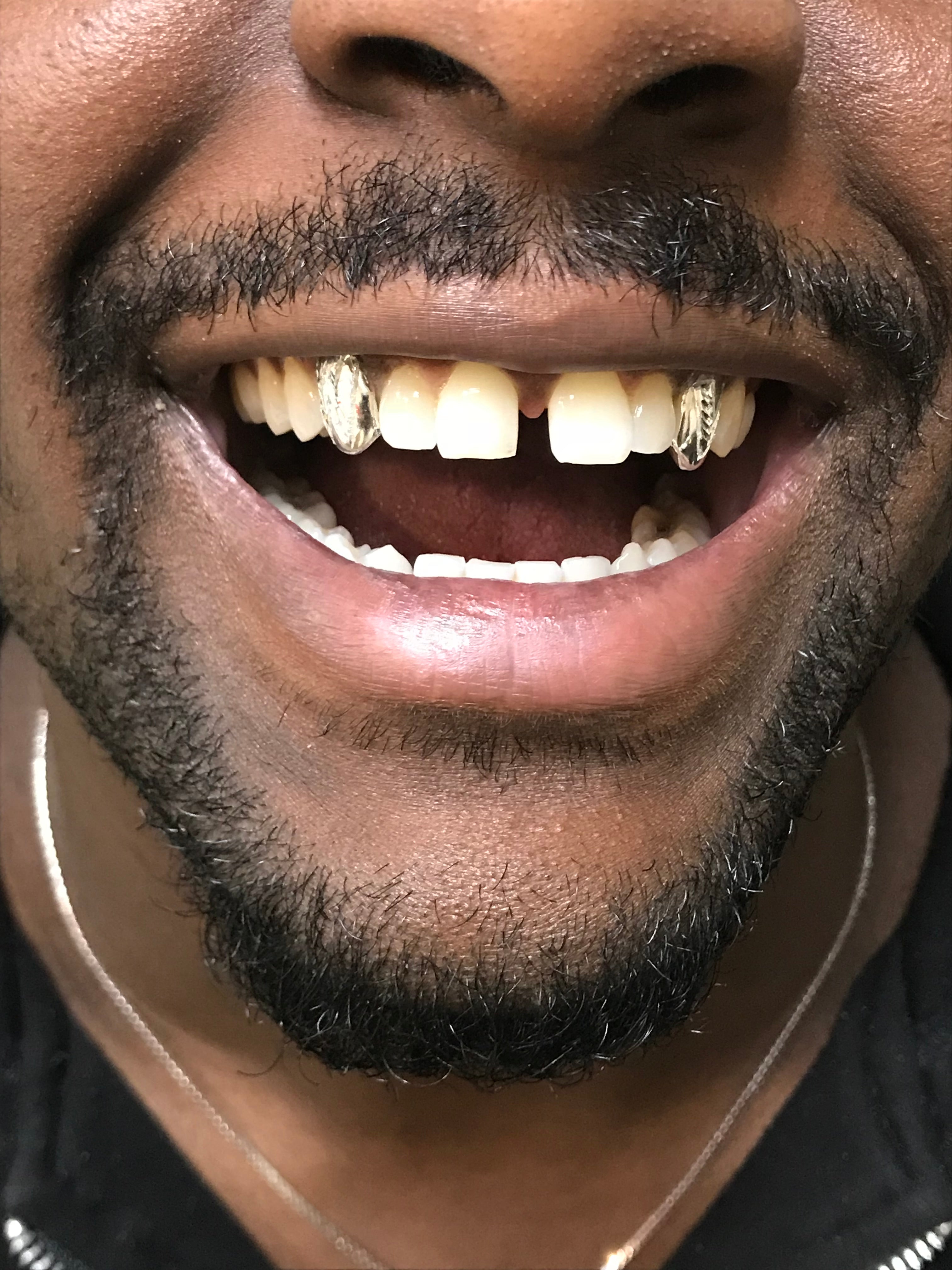 2 Silver Teeth